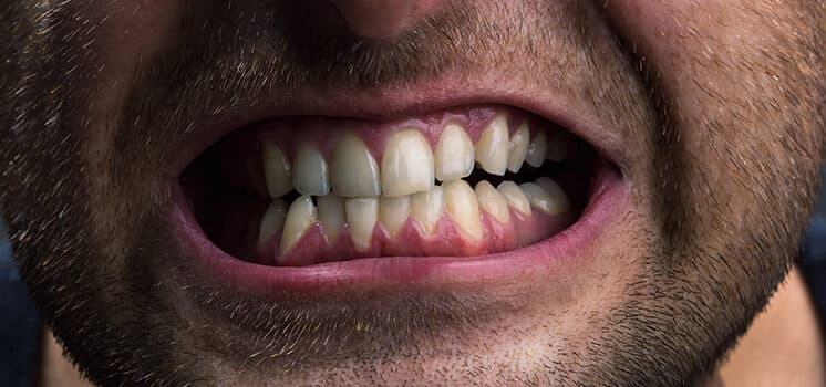Imagem ilustrativa: Bruxismo: Causas, Sintomas e a Visão do Otorrino